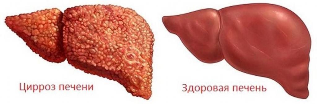 Современные методы лечения цирроза печени