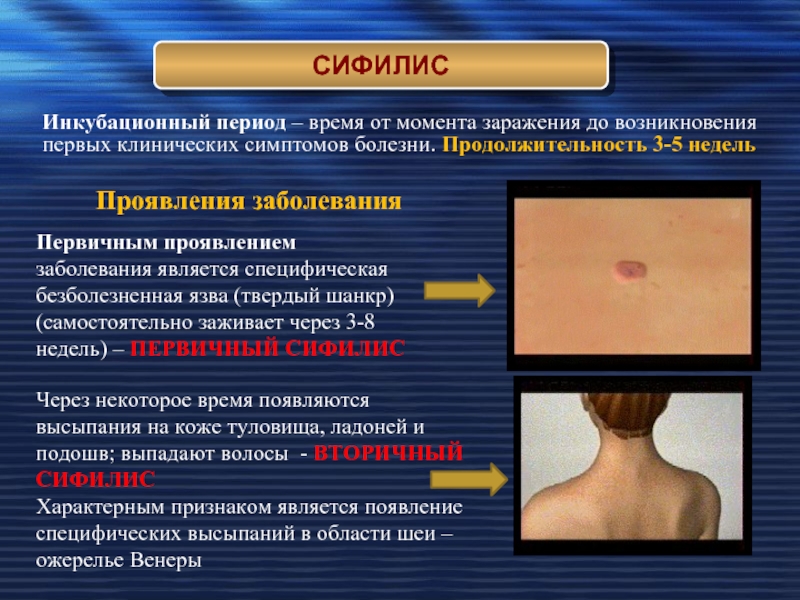 Сифилис: причины, диагностика и лечение