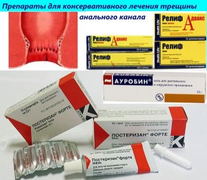 Анальные трещины: необходимость комплексного лечения