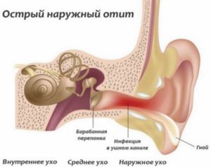 Причины воспаления уха