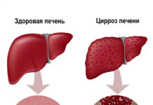 Цирроз печени: лечение, симптомы